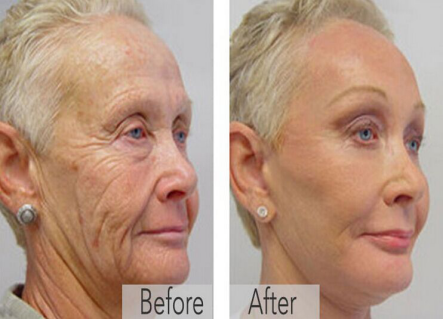 Cosmetic Wrinkle Removal face Lifting HIFU